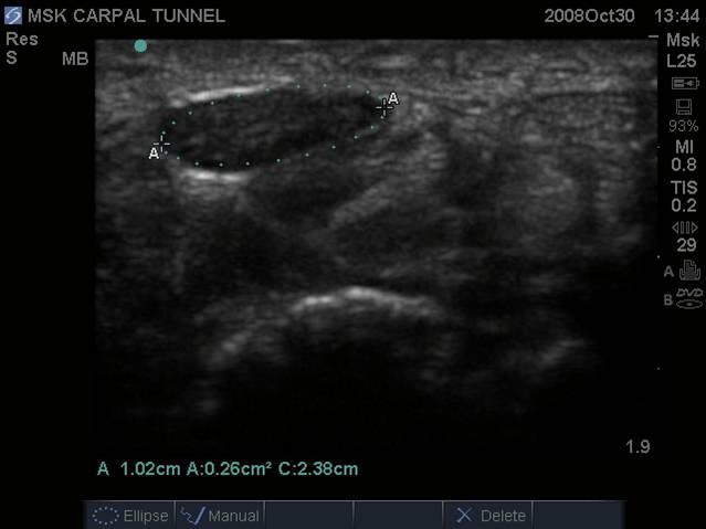 Median nerve in the carpal tunnel