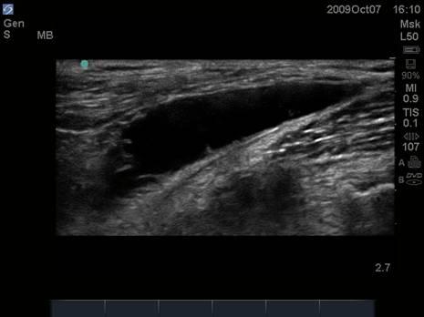 Baker's Cyst